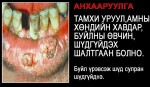 Mongolia 2010 Health Effects mouth - diseased organ, gross